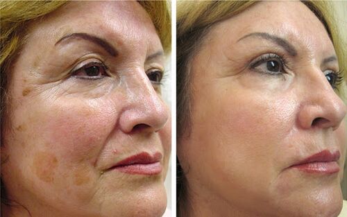 Anna from Wroclaw has a noticeable effect in smoothing wrinkles and tightening facial contours after using Canabilab