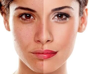 facial skin changes after laser exfoliation