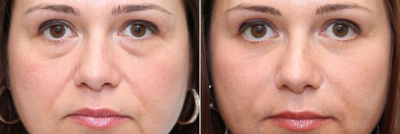 Before and after blepharoplasty - removal of fatty bodies under the eyes and skin tightening