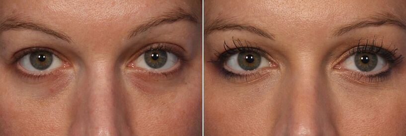 Before and after the use of injectable fillers - reduction of circles under the eyes